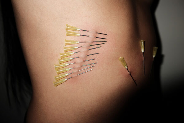 A series of acupuncture needles arranged in a neat row through the skin of someone's torso.